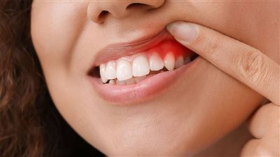 علاج التهاب اللثة سريع المفعول بـ 7 طرق منزلية.. انتبه للأعراض المؤلمة
