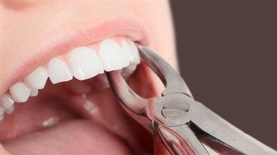 ما بعد خلع الضرس.. ابتعد عن المشروبات الساخنة 