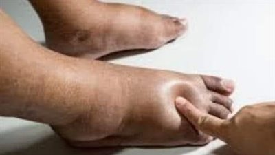 علاج احتباس السوائل في الجسم.. مدرات البول افضل حل 