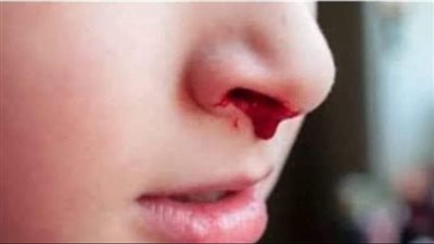 علاج الرعاف.. الكي الكيميائي والجراحة وسيلة ناجعة