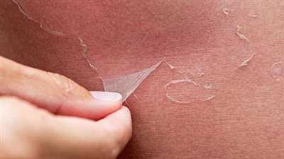 علاج حروق الشمس بزيت الزيتون.. طريقة استعماله بعد الخروج من البحر