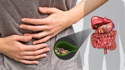 ما هى متلازمة ما بعد استئصال المرارة؟ وما هى اعراضها؟