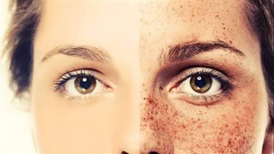 البقع الداكنة في الوجه.. انواعها ولماذا تظهر؟