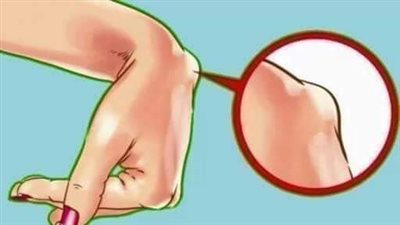 علاج الأكياس الدهنية.. الفرق بينها وبين الأورام 