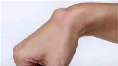 أعراض الكيس الدهني والفئات الأكثر عرضة لظهوره
