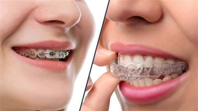 كيفية الاعتناء بالاسنان مع وجود التقويم.. لا تعط البكتيريا فرصة للنمو