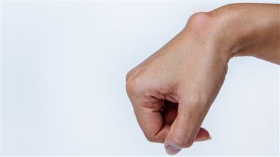 جراحة الكيس الزلالى.. متى تكون عاجلة؟