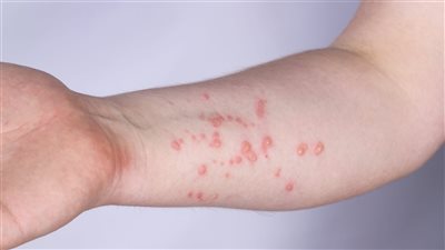 الصحة العالمية: وضع تفشي جدري القرود في الكونغو مثير للقلق