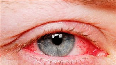 أسباب احمرار العين.. 11 سببا محتملا