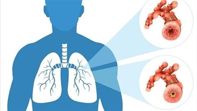 أعراض رئة الفشار.. 5 علامات أساسية