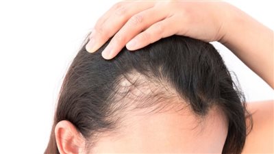 انحسار خط الشعر.. أسبابه وطرق حديثة لعلاجه