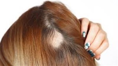 علامات وأعراض الثعلبة لكل أنواعها.. تعرف عليها