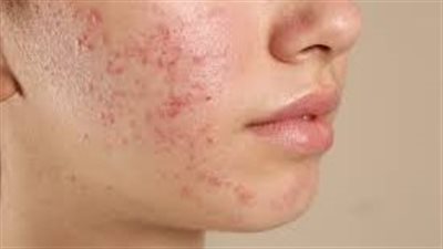حب الشباب الفطري.. الأعراض والأسباب وخيارات العلاج