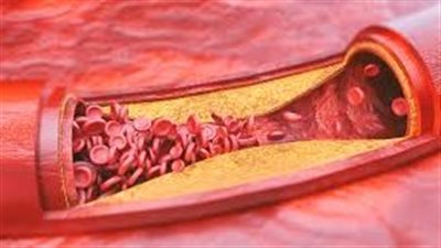 تصلب الشرايين.. أسبابه وأعراضه وعلاجاته