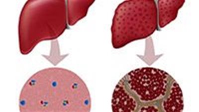 تلف الكبد.. 9 أشياء تسبب تليف وتندب الكبد