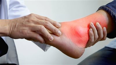 أعراض النقرس.. 4 علامات رئيسية