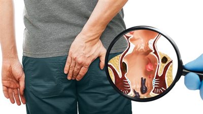 البواسير الخارجية.. 6 معلومات مهمة لكل مريض بواسير