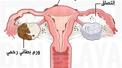 مراحل الانتباذ البطاني الرحمي الأربع ومعانيها