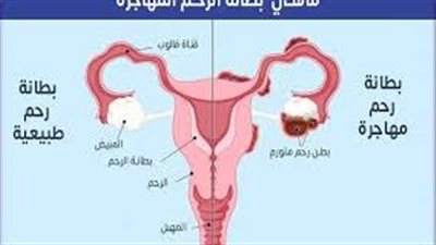 تشخيص مرض بطانة الرحم المهاجرة.. 3 فحوصات مهمة