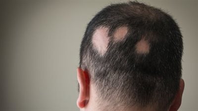 علاج داء الثعلبة البقعية والاندروجينية.. أدوية وتقنيات تجميلية