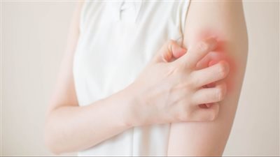 حساسية السكر.. الأعراض والعلاج