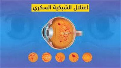 اعتلال الشبكية السكري.. الأسباب والأعراض