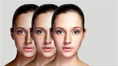 طريقة تنظيف البشرة من النمش.. وصفات طبيعية وأخرى تجميلية بالليزر والتبريد